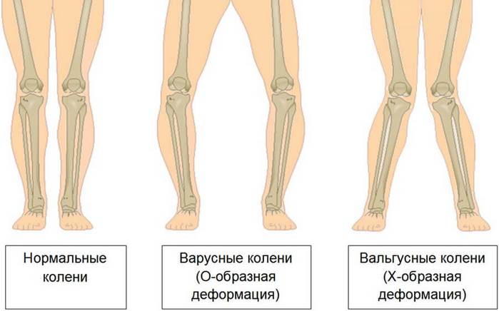 Гонартроз - Бодибилдинг форум AnabolicShops