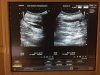 Густая кровь на курсе. Высокий гематокрит. Слив крови - Бодибилдинг форум AnabolicShops